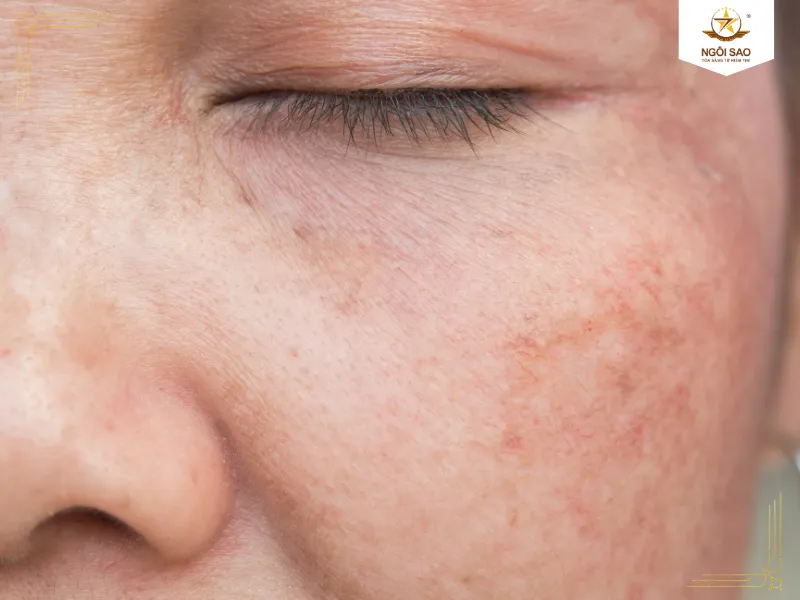 Tác hại nghiêm trọng của ánh sáng mặt trời nếu không kiểm soát