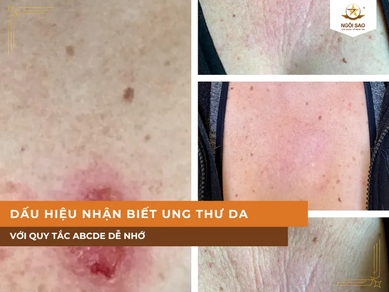 Dấu Hiệu Nhận Biết Ung Thư Da Giai Đoạn Đầu Với Quy Tắc ABCDE Dễ Nhớ