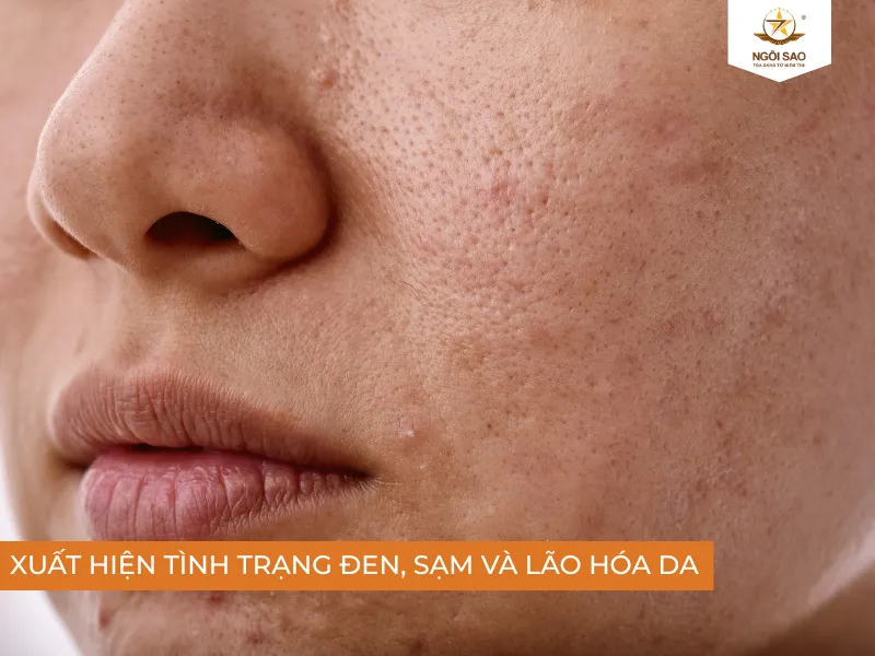 Tia cực tím UV gây tình trạng lão hóa da, sạm đen mất thẩm mỹ