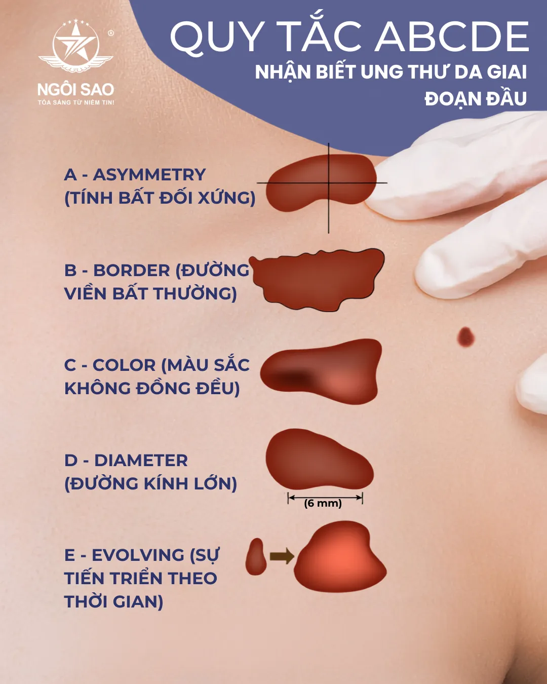 Dấu Hiệu Nhận Biết Ung Thư Da Giai Đoạn Đầu Với Quy Tắc ABCDE Dễ Nhớ 
