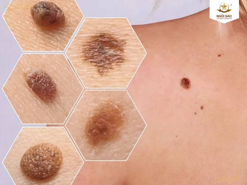 Bảng so sánh trực quan giữa nốt ruồi lành tính với nốt ruồi ung thư da