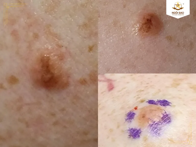 Dấu Hiệu Nhận Biết Ung Thư Da Giai Đoạn Đầu Với Quy Tắc ABCDE Dễ Nhớ 