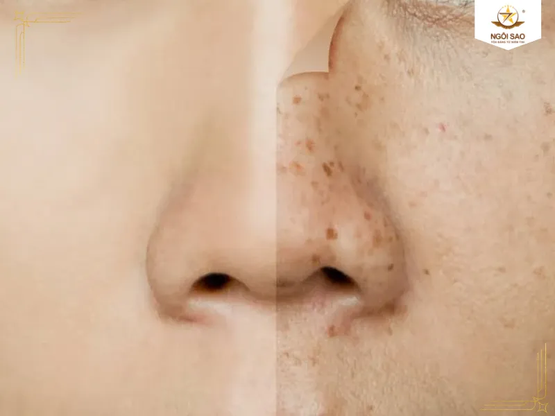 Phá hủy collagen và đẩy nhanh quá trình lão hóa da nhiệt (Thermal Aging) |. Tác hại của tia hồng ngoại đến sức khỏe và giải pháp ngăn chặn hiệu quả